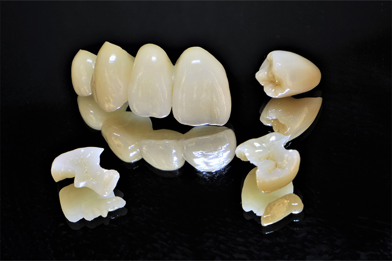 歯の欠損が少数の場合はブリッジでの補修も行っています