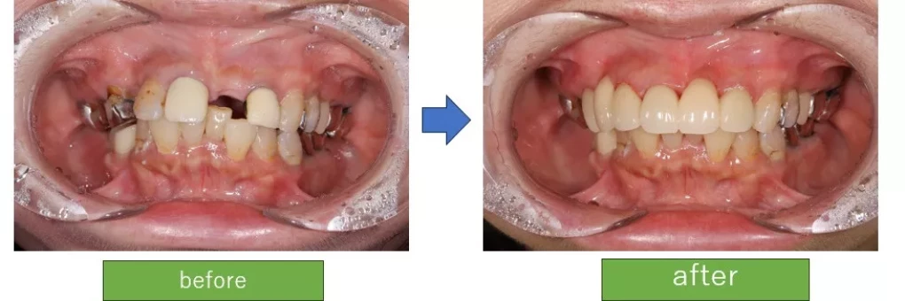 症例紹介(ジルコニアセラミック)