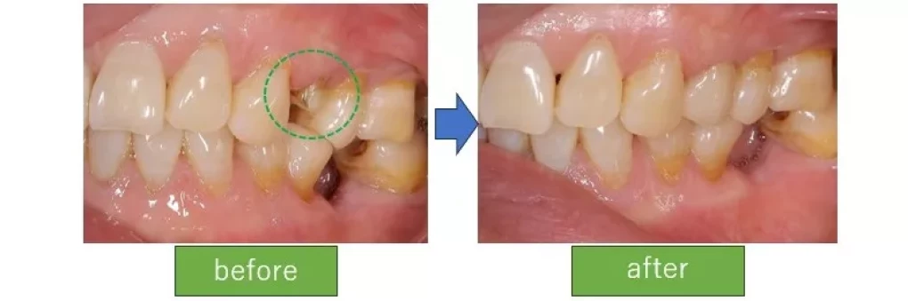 症例紹介｛通常のセラミッククラウン(e-max)｝