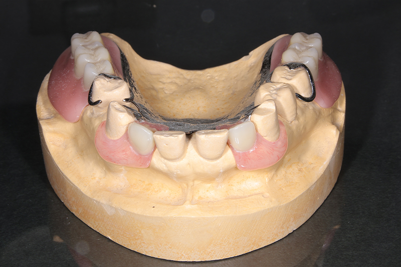 当医院では入れ歯の治療や補修も行っています