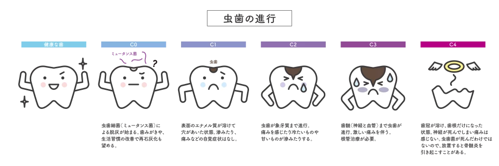 虫歯予防のための３つのポイント