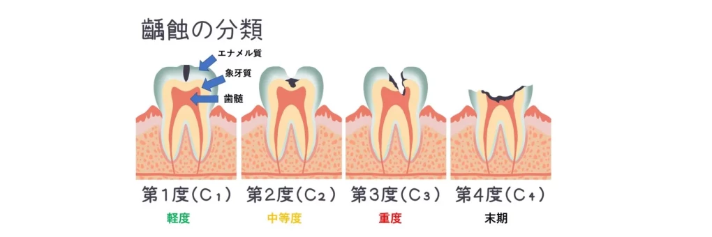 虫歯の進行と治療方法