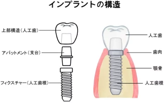 インプラントは様々な選択肢の１つ