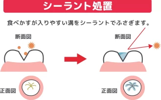 奥歯の虫歯予防にはシーラントが効果的