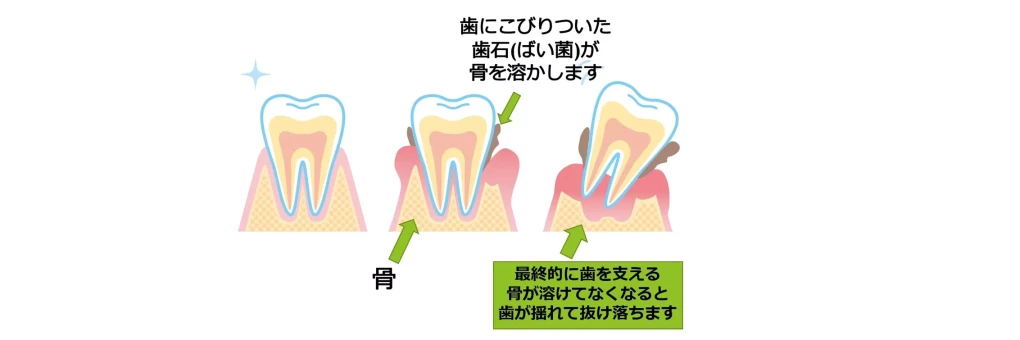 静かに忍び寄る「やがては全てが抜け落ちる」恐ろしい病気