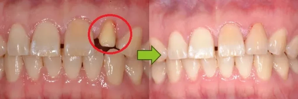 ①ジルコニアボンドクラウン(前歯)　110,000(税込121,000円)