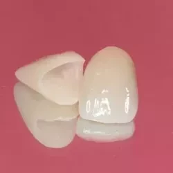 ②セラミッククラウン(e-max)(前歯)　90,000(税込99,000円)