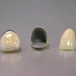 ③メタルボンドクラウン(前歯)　100,000円(税込110,000円)