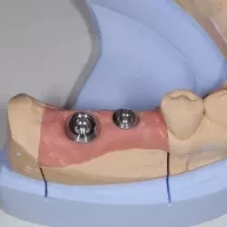 ②インプラント埋入(手術)　220,000円(税込242,000円)