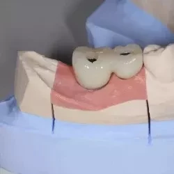 ⑤被せ物(ジルコニアクラウン)　110,000円(税込121,000円)