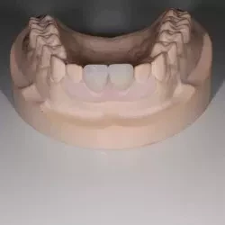 ①スマイルデンチャー片側　100,000円(税込110,000円)