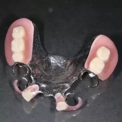 ③チタン床義歯　350,000円(税込385,000円)