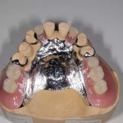 ④コバルトクロム義歯　250,000円(税込275,000円)